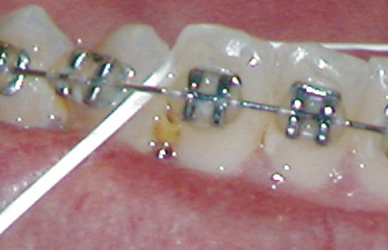 food stuck in teeth on metal braces | kids dentist near me