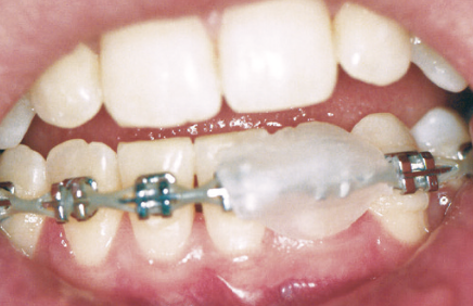 wax on metal braces | orthodontics apple valley mn