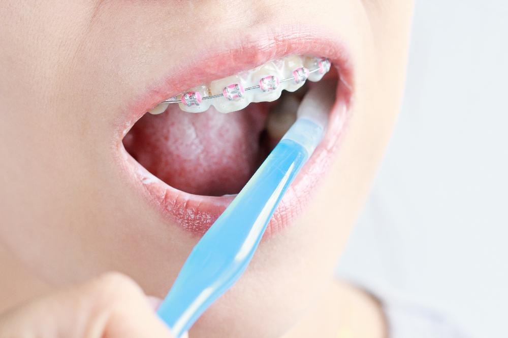 person brushing teeth with braces | orthodontics apple valley mn