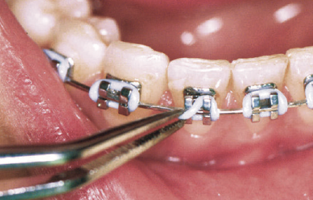 ligature off on metal braces | dentists near me