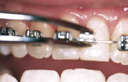 close up of loose brackets | dentist apple valley mn