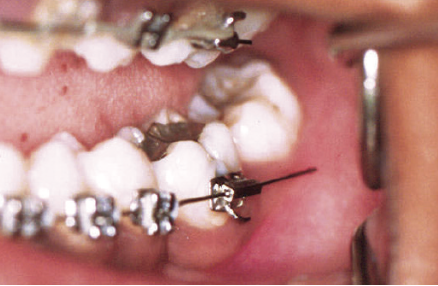 protruding wire on braces | braces apple valley mn