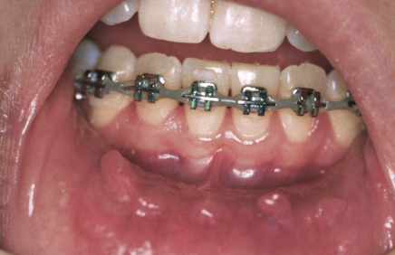 mouth sores on dental patient | dentist near me