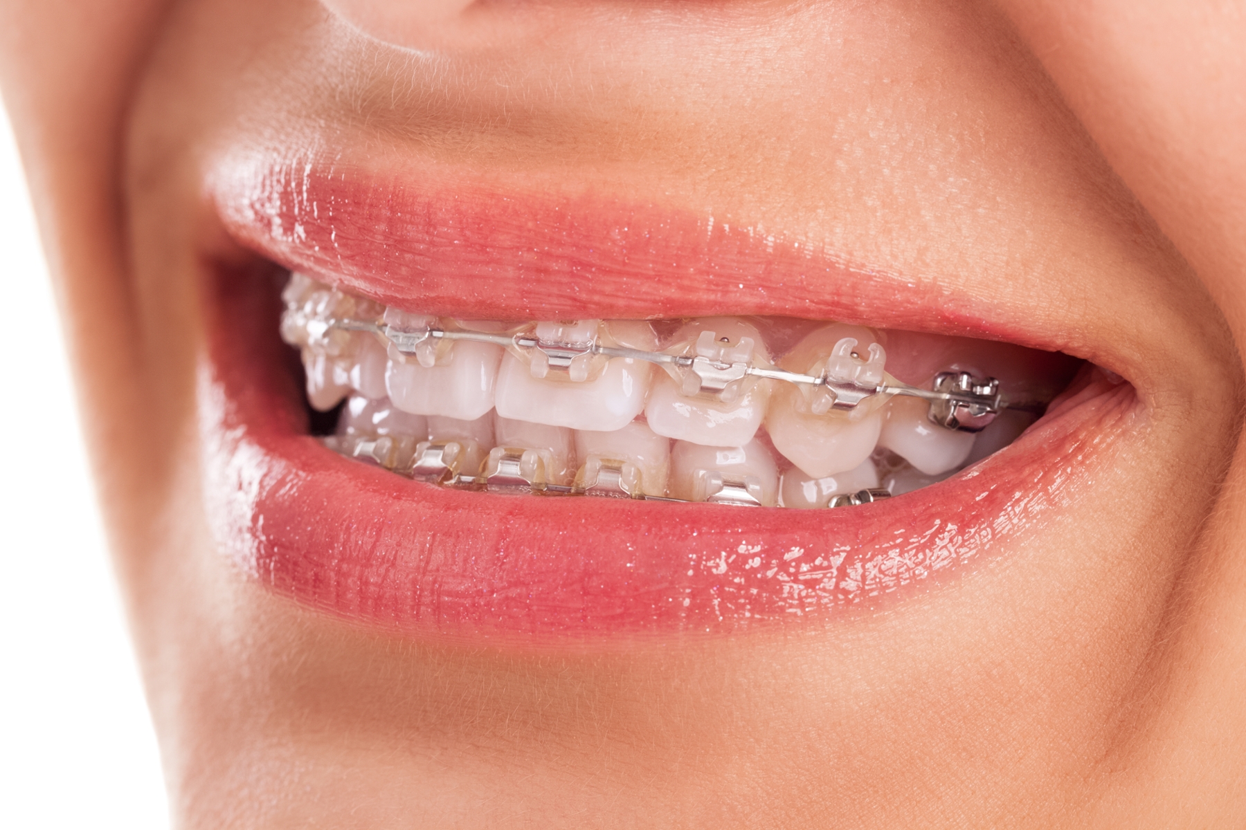 close up of smiling mouth with braces in apple valley mn