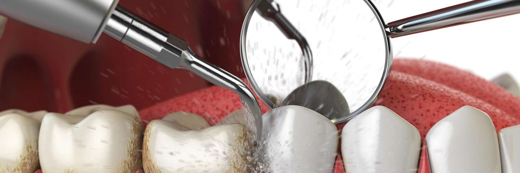dental tool in tooth | dentist apple valley mn