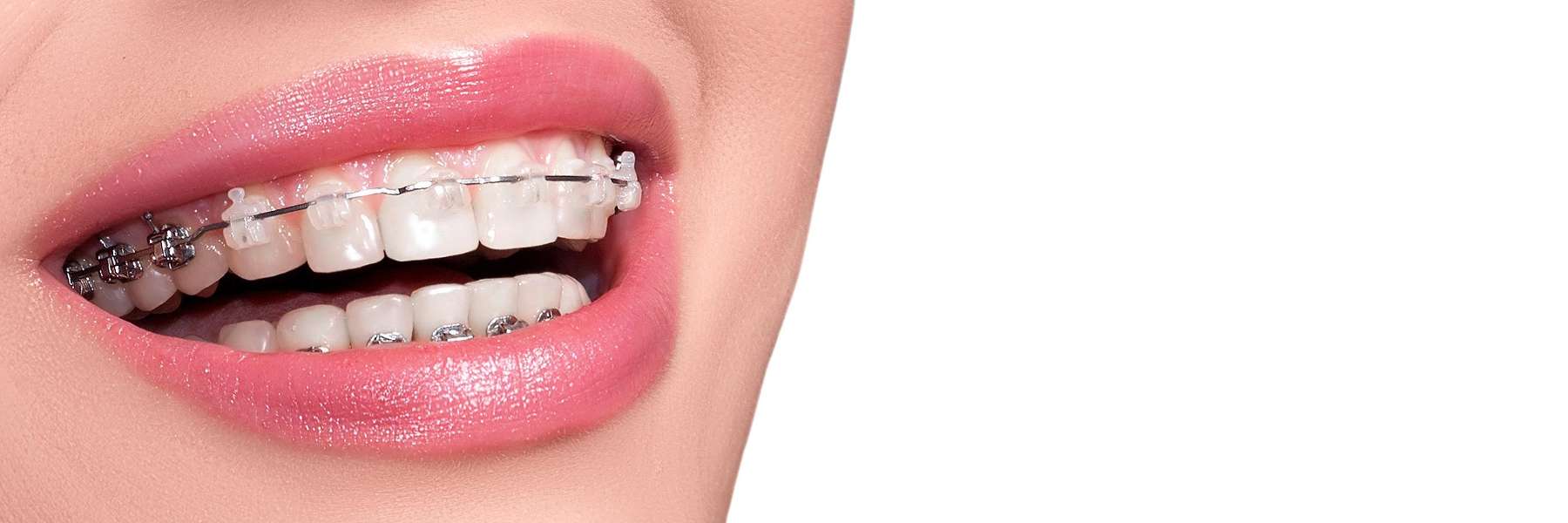 close up of braces | dentist apple valley mn