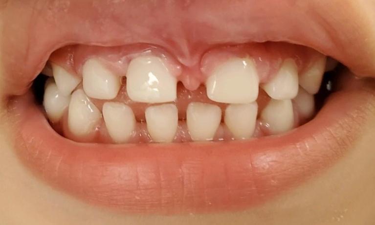 longer teeth after dental crowns l dentist 55124