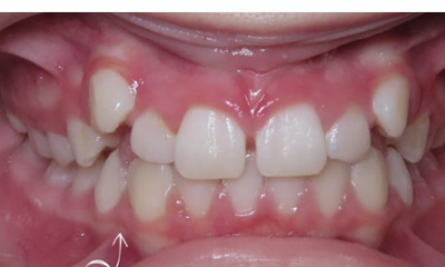 Orthodontic-Transformation-Correcting-Crowded-Teeth-and-High-Canines-Before-Image